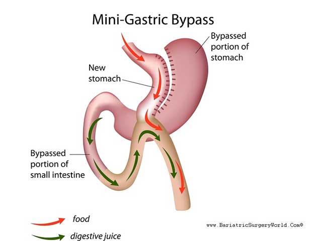 Revisional Weight Loss Surgery